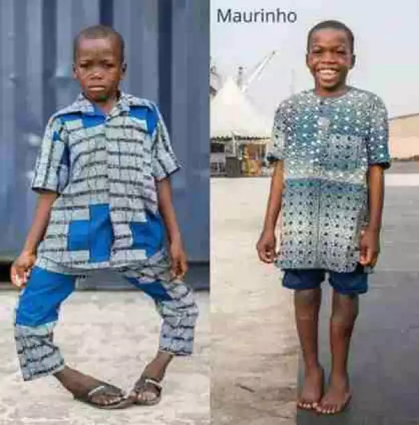 Young Boy With Bow Legs Undergoes Surgery (See Before & After Photos)